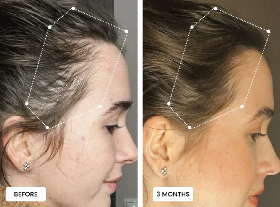 Boost Hair Growth Naturally with 3-in-1 Red Light Therapy Wand | LUMILUX